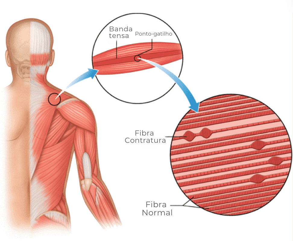agulhamento a seco inativa os ponto-gatilhos acabando com a dor muscular